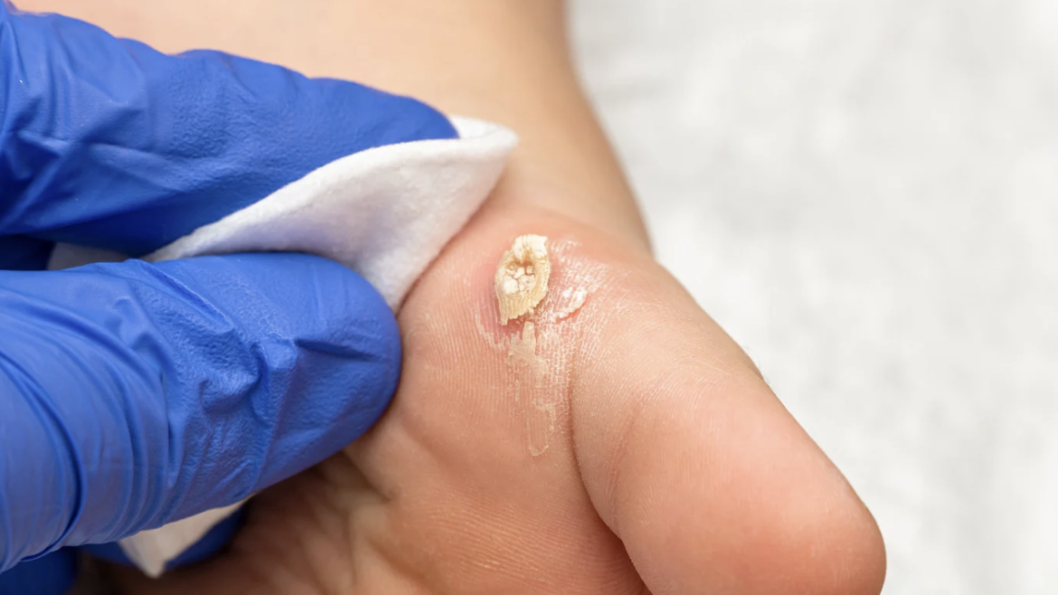 Wart and Skin Tag Removal Appointment Near McLean, VA